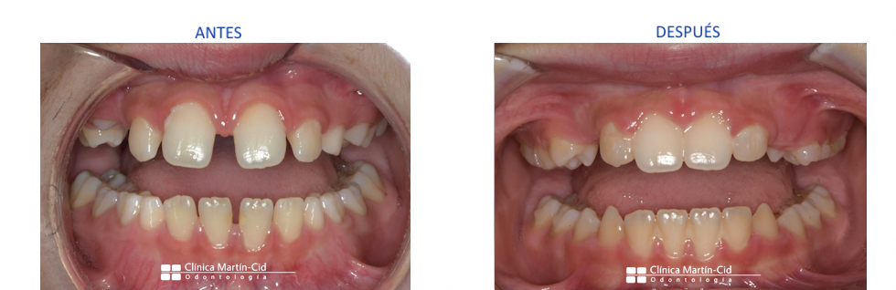 caso1-alineadores-dentales-clinicamartincid