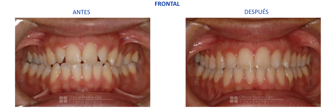 caso1 ortodoncia