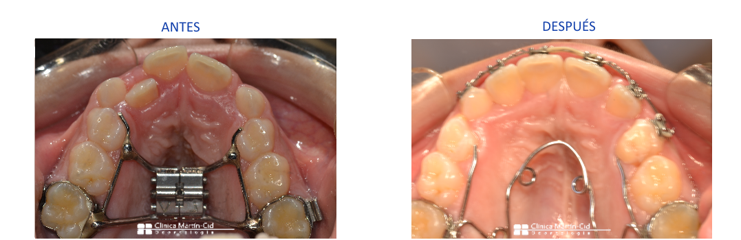 caso12 ortodoncia