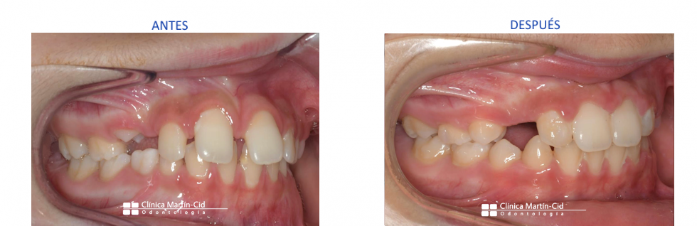 caso2-alineadores-dentales-clinicamartincid