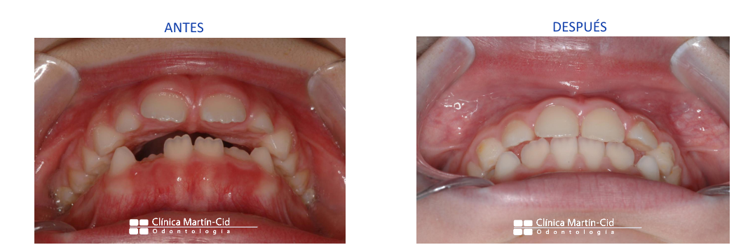 caso ortodoncia en niños en Alcalá de Henares