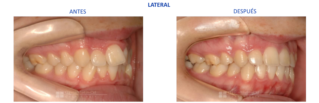 caso3 ortodoncia