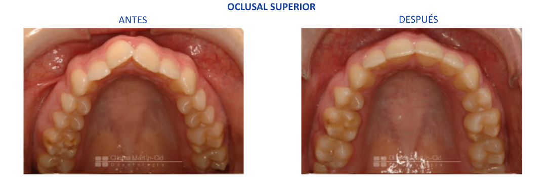 caso5 ortodoncia