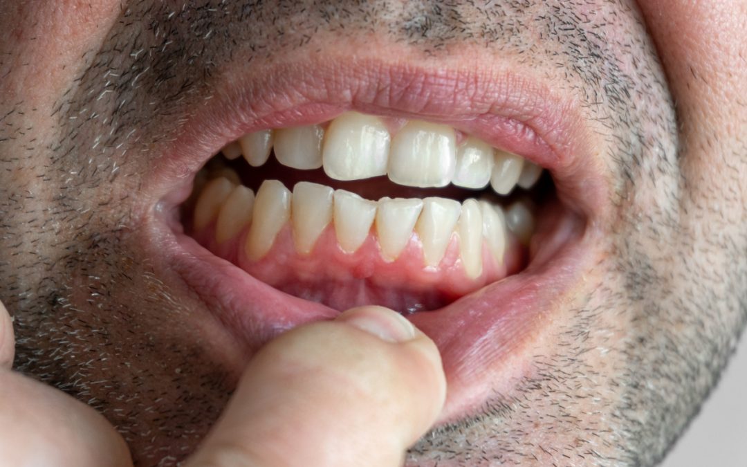 ¿Cómo evitar la erosión dental?