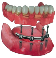 implantes dentales baratos