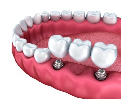 implantes dentales baratos