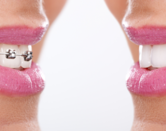 tratarmiento de ortodoncia en adultos