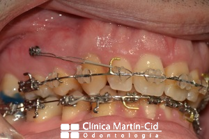 tratamiento ortodoncia con microtornillos