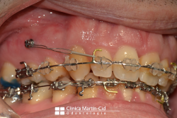 Uso-de-microtornillos-en-ortodoncia